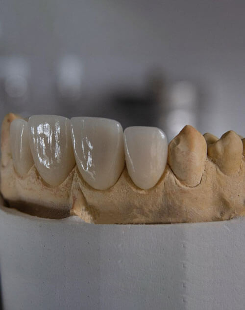 Cavities and Fillings